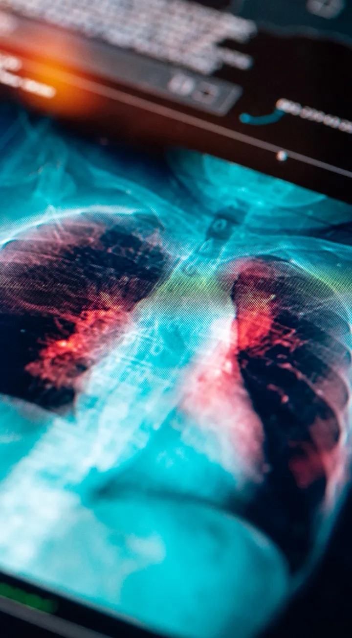 Estudio radiológico de tórax en servicio de diagnóstico de neumología por imágenes en Clínica Reina Sofía.